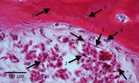 Abb. 16 Dieses Bild zeigt die Zerstörung einer Blutkapillare mit austreten-dem Blut (2). Es sind noch Reste der inneren Gefäßauskleidung, Endothelzellen (1), vorhanden